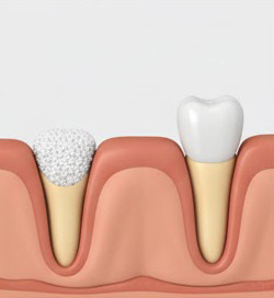 Bone Grafting