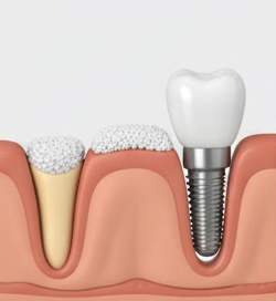 Bone Grafting