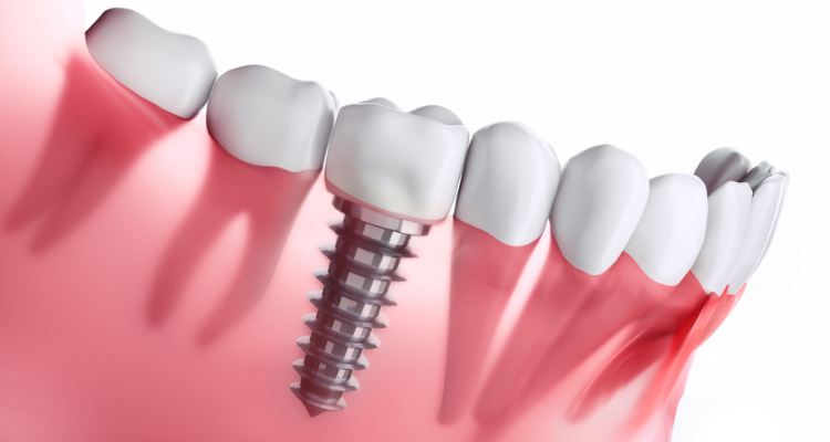 dental implant fairhope al