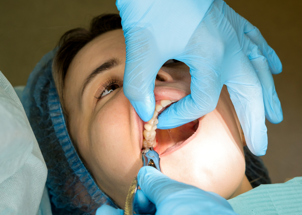Teeth Extractions
