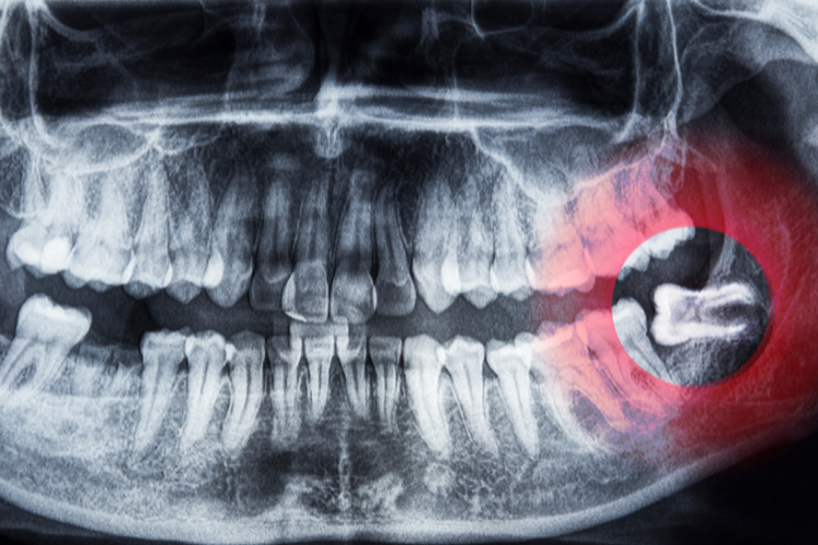 wisdom teeth fairhope al