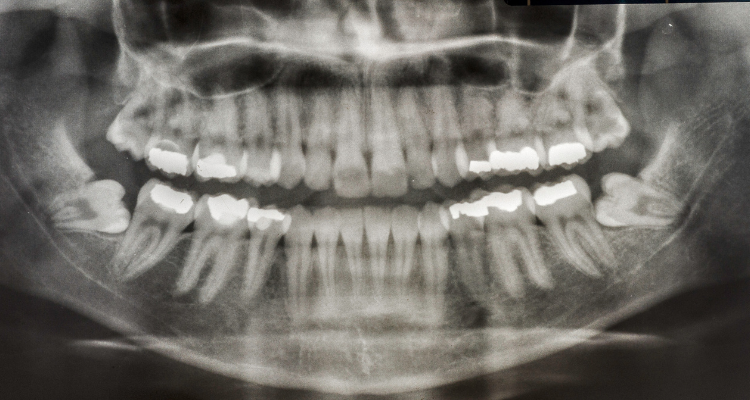 wisdom teeth fairhope al