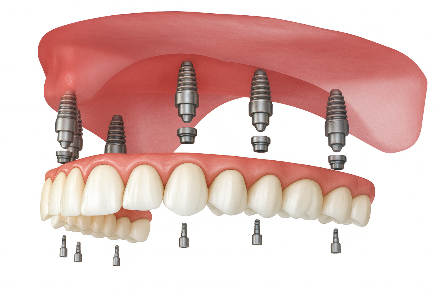 implant supported denture fairhope al